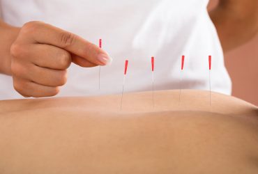 Acupuncture, Acupressure & Dry Needling Therapy